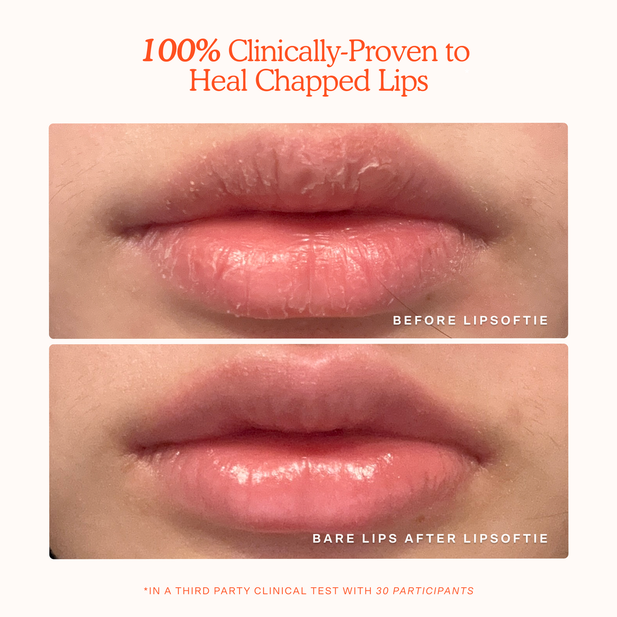LipSoftie® Lip Treatment D6
