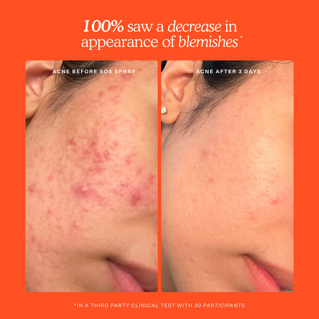 SOS 3-Step Skincare Set G5