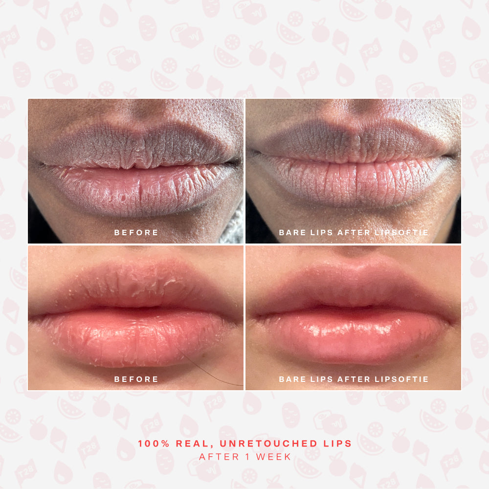 SOS LipSoftie® Lip Treatment J3