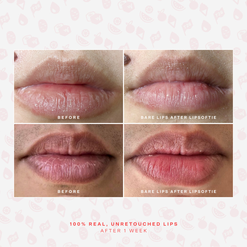 SOS LipSoftie® Lip Treatment P3
